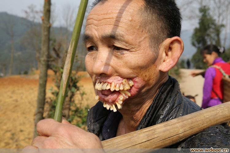 贵州一男子被狼"舔"后 牙齿外翻长相恐怖