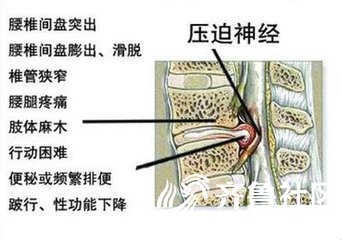 腰椎间盘突出患者最常用的治疗方法大致有:药物,牵引,按摩推拿,针灸等